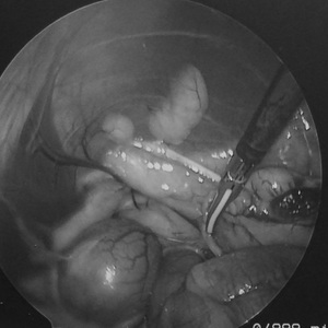 腹腔鏡による潜在精巣摘出