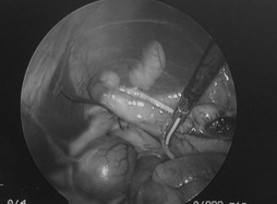 腹腔鏡による潜在精巣摘出