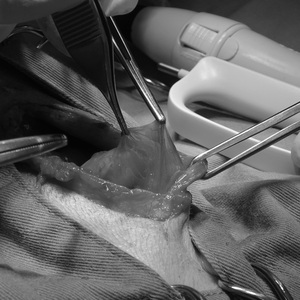 被嚢性腹膜硬化症が増えております。