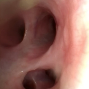 気管支内視鏡検査