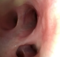 気管支内視鏡検査